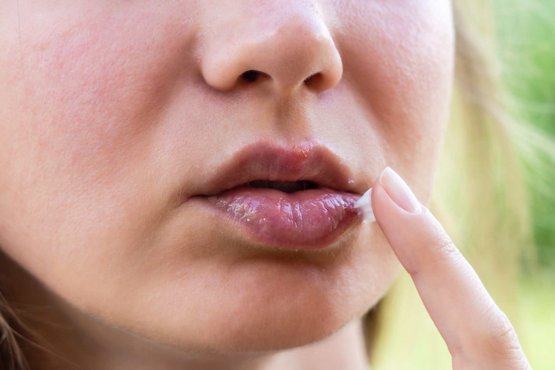 Herpes labial: cómo curarlo rápido y qué crema funciona de verdad